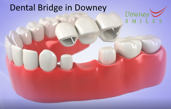 Dental Bridge in Downey