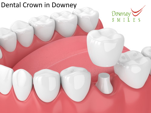 Dental Crowns in Downey