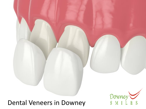 Dental Veneers in Downey