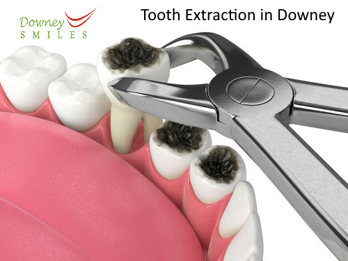 Dental Extraction in Downey