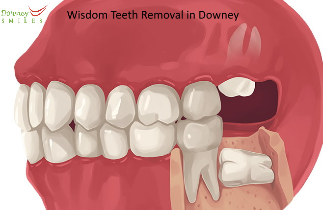 Wisdom Teeth Extraction in Downey