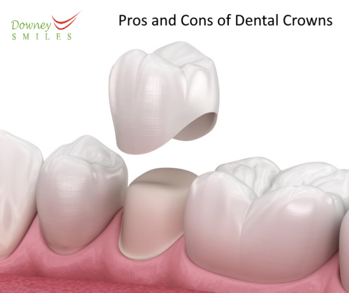 Pros and Cons of Dental Crowns